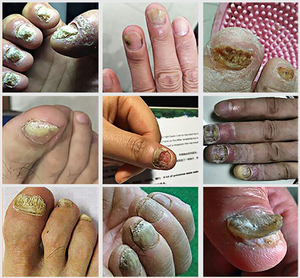 Poderoso tratamiento para combatir los hongos de las uñas NONYX NAIL GEL ⭐⭐⭐⭐⭐